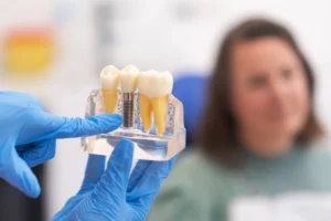 Model implantu zębowego prezentowany podczas konsultacji implantologicznej